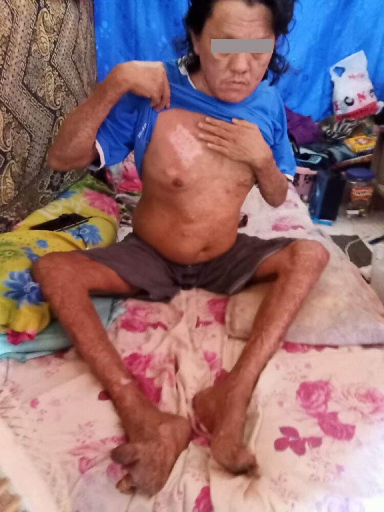 Respon Cepat Laporan Masyarakat, Bupati Beri Bantuan Kepada Keluarga Penderita Kusta